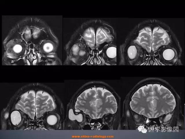 【病例】眼眶表皮样囊肿1例CT及MR影像表现
