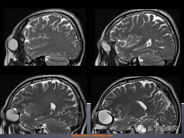 【病例】眼眶表皮样囊肿1例CT及MR影像表现