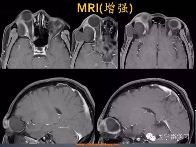 【病例】眼眶表皮样囊肿1例CT及MR影像表现