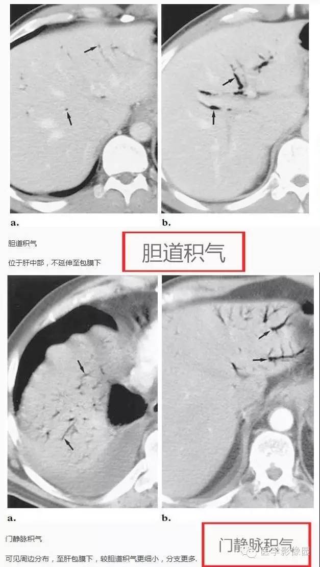 “胆管积气征”&“门静脉积气征” “胆管积气征”&“门静脉积气征”