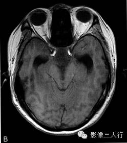 【病例】成人型毛细胞型星形细胞瘤1例MR影像表现 【病例】成人型毛细胞型星形细胞瘤1例MR影像表现