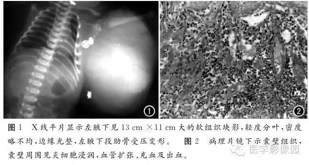 这些部位的“支气管囊肿”你见过吗？