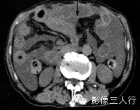 6种腹膜疾病的CT鉴别