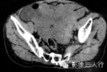6种腹膜疾病的CT鉴别