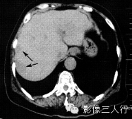 6种腹膜疾病的CT鉴别
