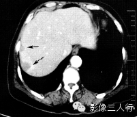 6种腹膜疾病的CT鉴别