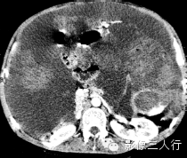 6种腹膜疾病的CT鉴别
