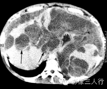 6种腹膜疾病的CT鉴别