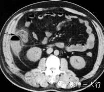6种腹膜疾病的CT鉴别