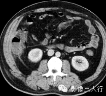 6种腹膜疾病的CT鉴别