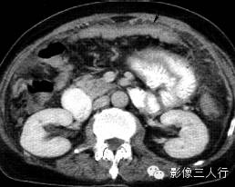 6种腹膜疾病的CT鉴别