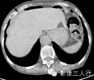 6种腹膜疾病的CT鉴别