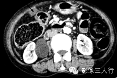 6种腹膜疾病的CT鉴别