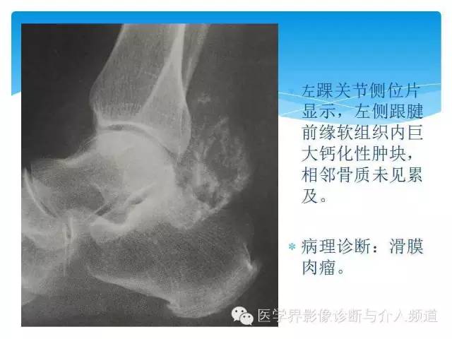 【PPT】滑膜肉瘤的影像诊断