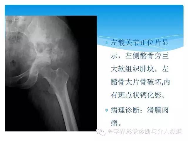 【PPT】滑膜肉瘤的影像诊断