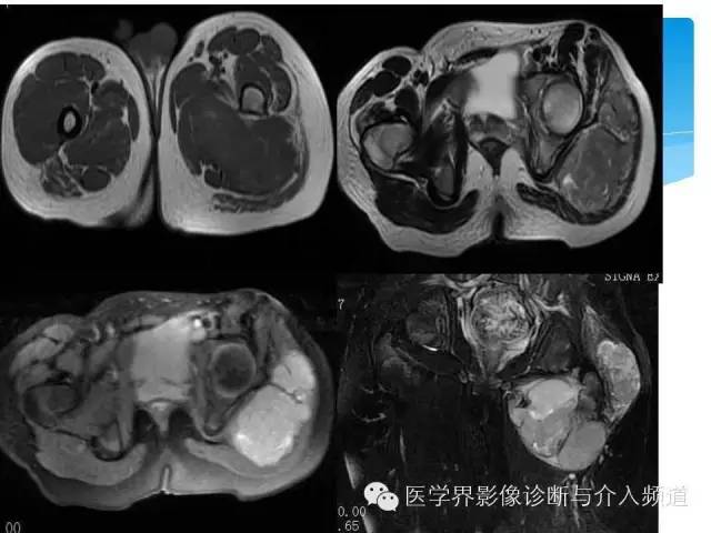 【PPT】滑膜肉瘤的影像诊断