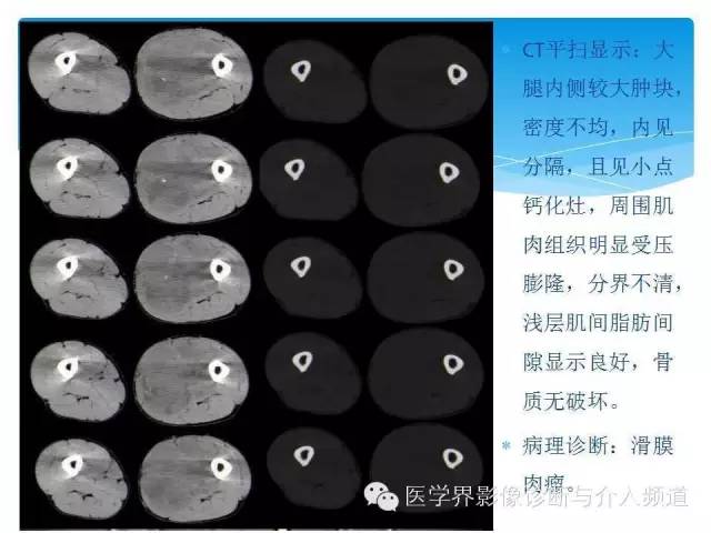 【PPT】滑膜肉瘤的影像诊断