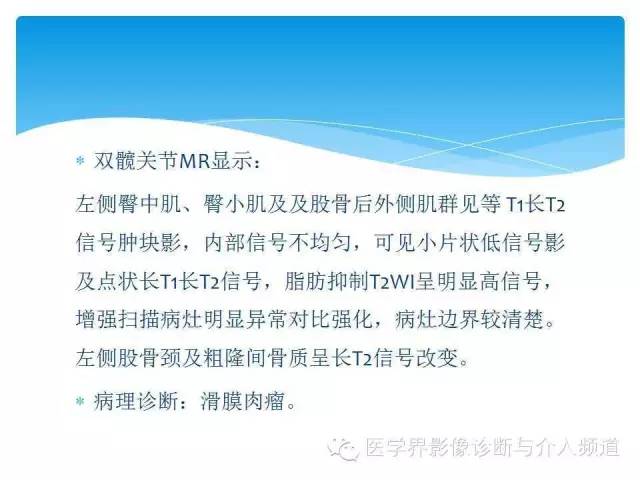 【PPT】滑膜肉瘤的影像诊断