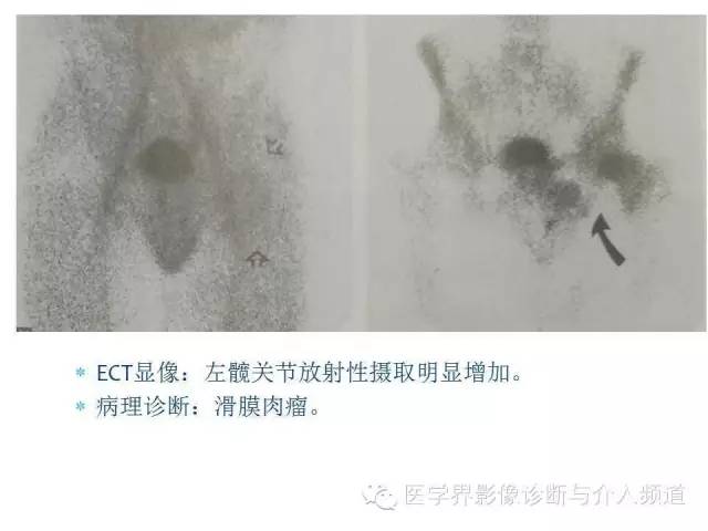 【PPT】滑膜肉瘤的影像诊断