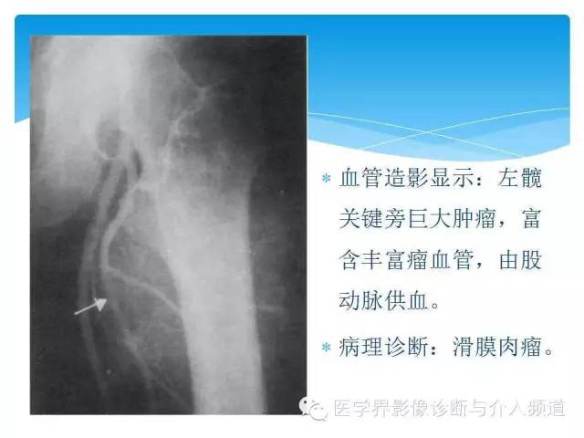【PPT】滑膜肉瘤的影像诊断