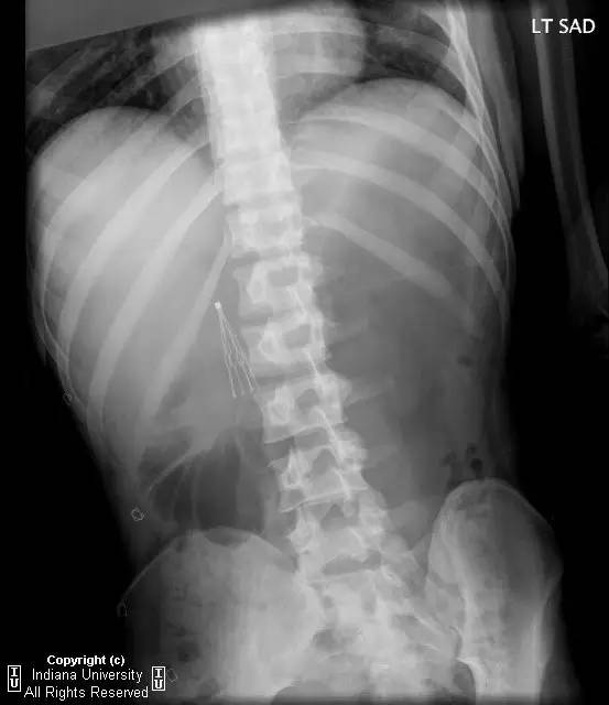 【病例】肠系膜上动脉综合征1例影像表现 【病例】肠系膜上动脉综合征1例影像表现