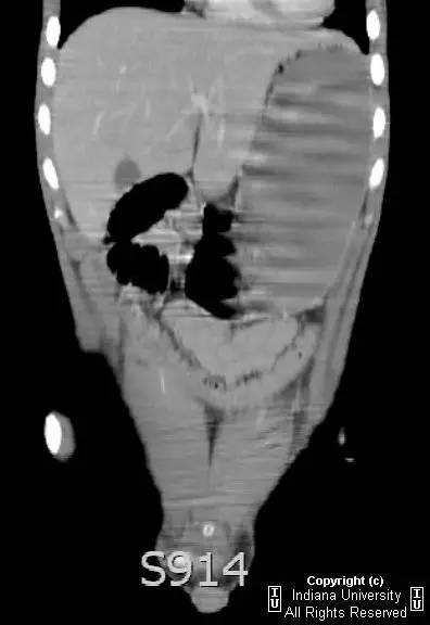 【病例】肠系膜上动脉综合征1例影像表现 【病例】肠系膜上动脉综合征1例影像表现