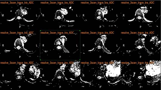 【病例】多发性骨髓瘤1例MR影像表现 【病例】多发性骨髓瘤1例MR影像表现