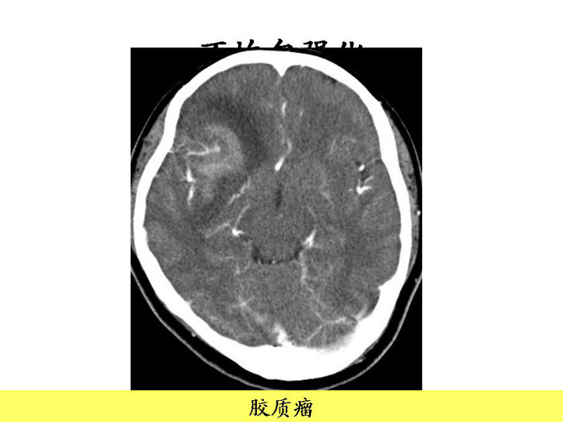 常见影像病例读片汇总