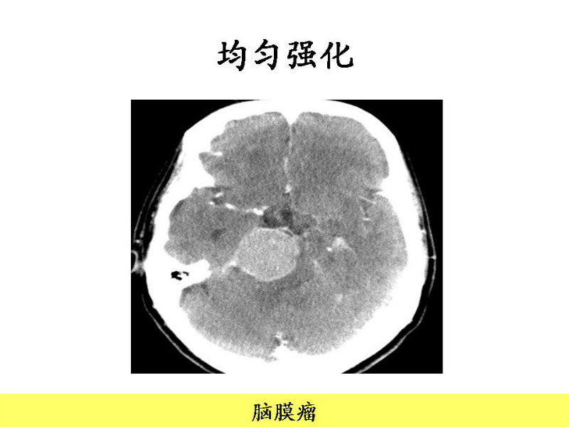 常见影像病例读片汇总