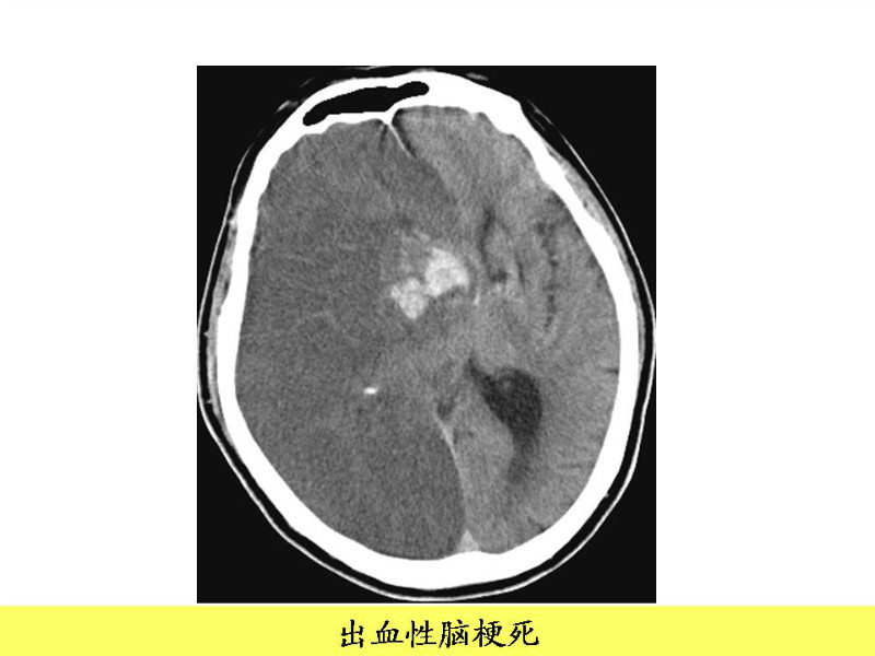 常见影像病例读片汇总