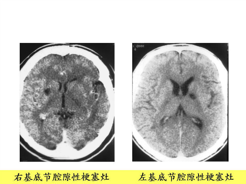 常见影像病例读片汇总