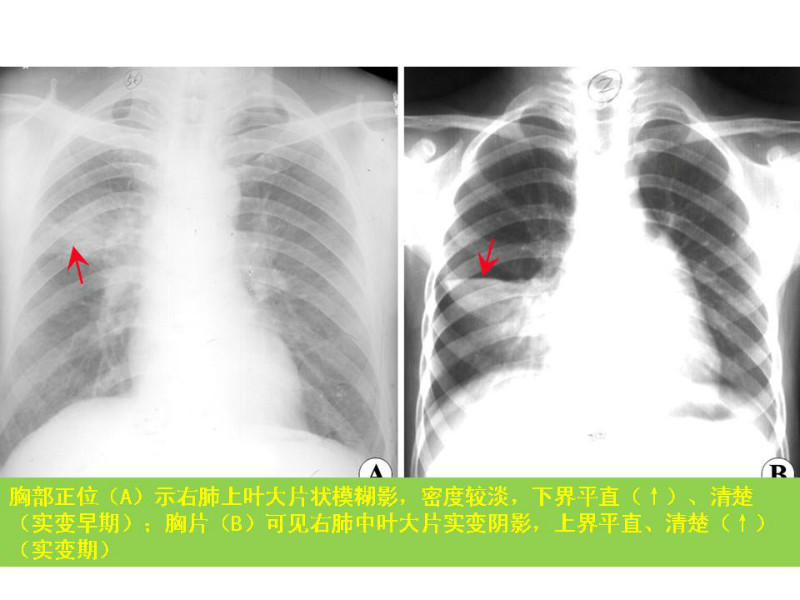 常见影像病例读片汇总
