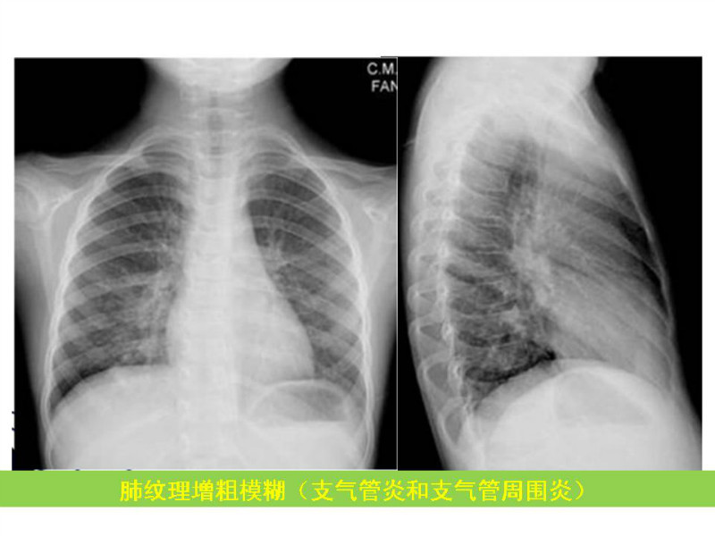 常见影像病例读片汇总