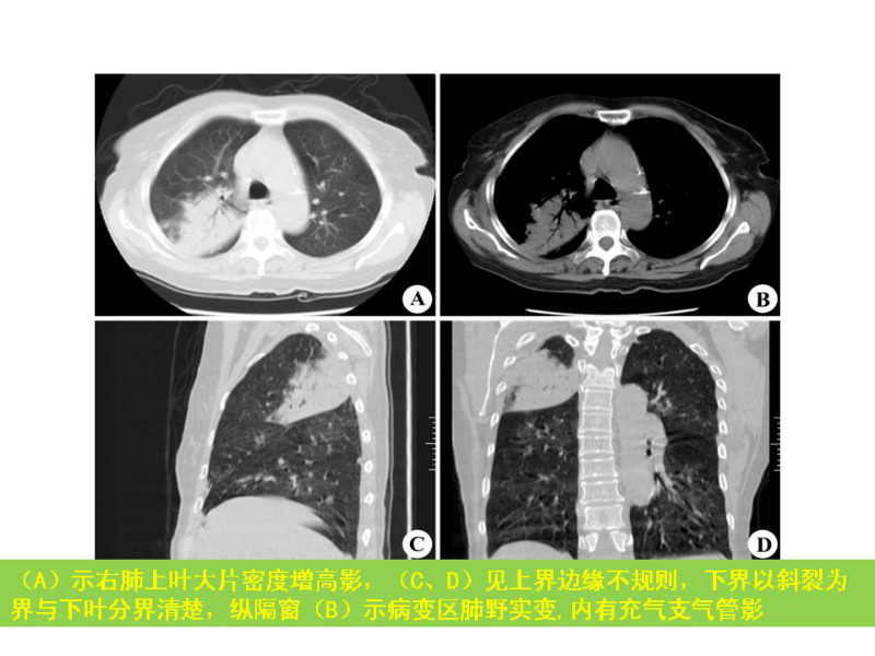 常见影像病例读片汇总
