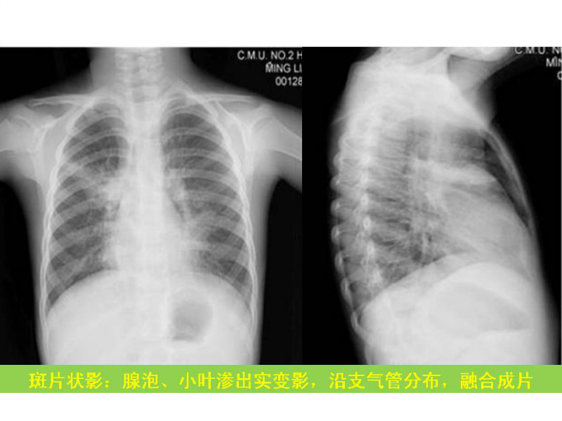常见影像病例读片汇总