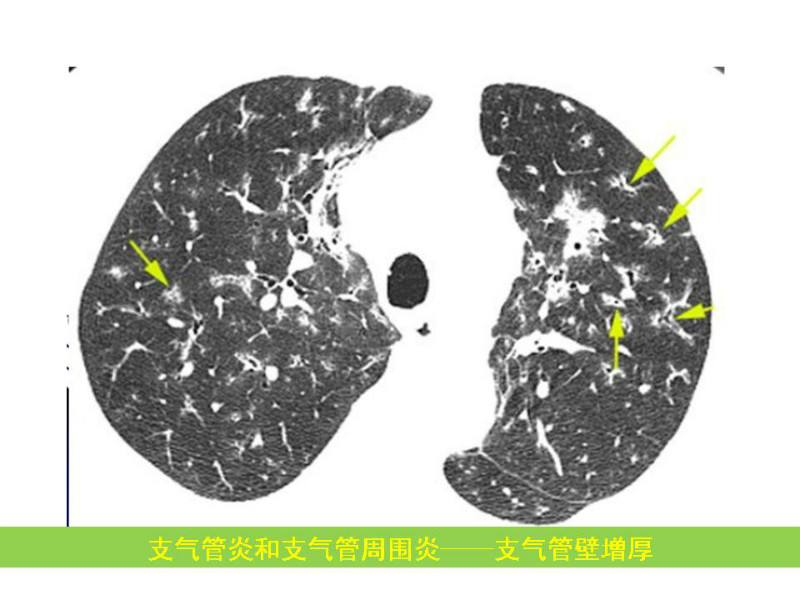 常见影像病例读片汇总