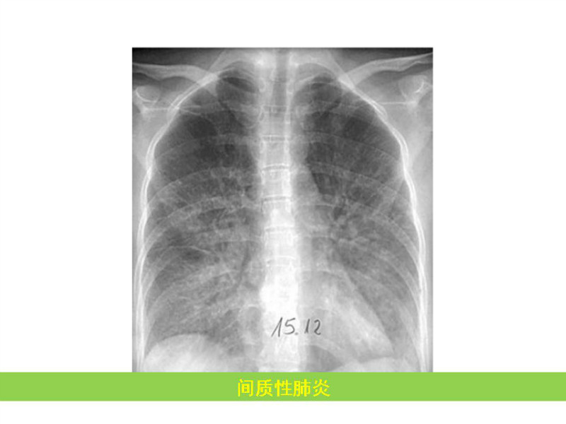常见影像病例读片汇总