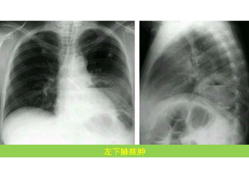 常见影像病例读片汇总