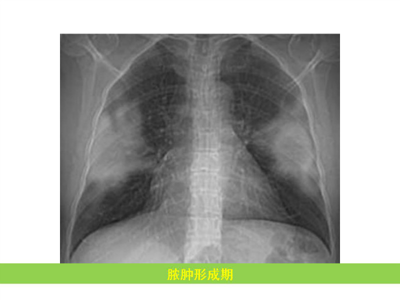 常见影像病例读片汇总