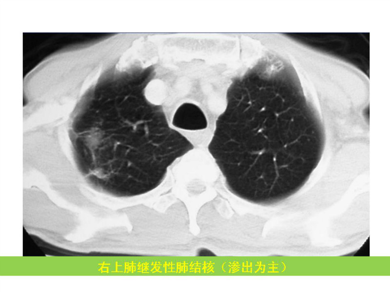 常见影像病例读片汇总