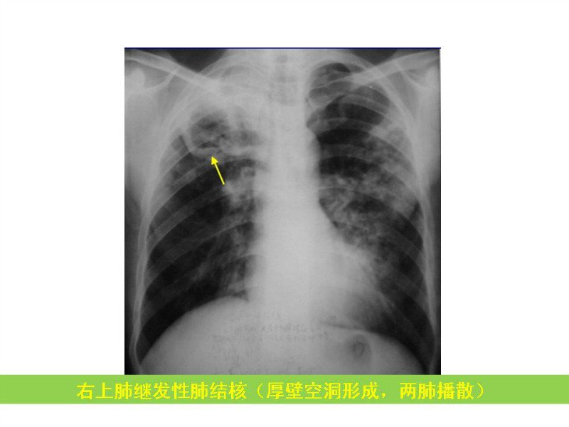 常见影像病例读片汇总