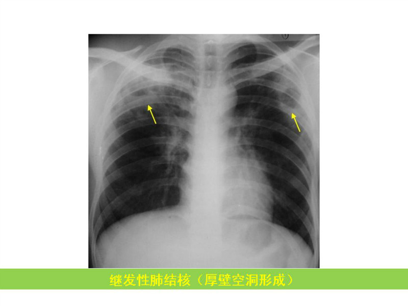常见影像病例读片汇总