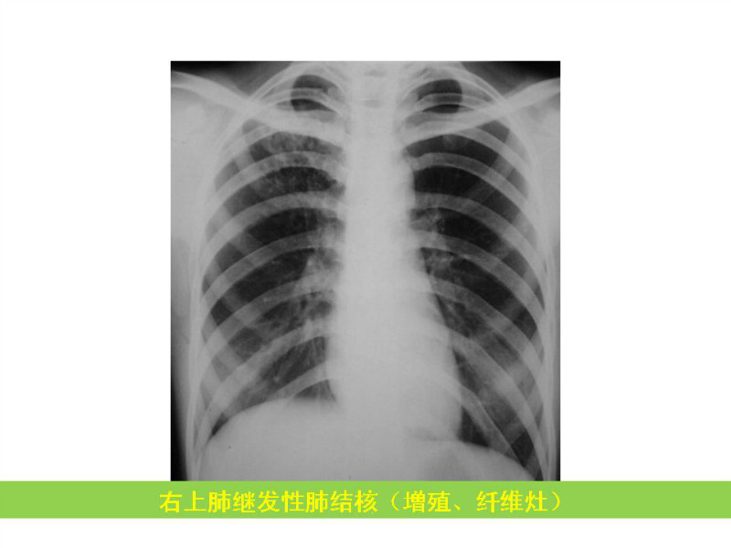 常见影像病例读片汇总
