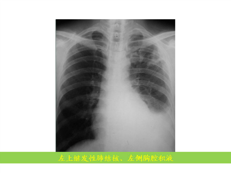 常见影像病例读片汇总