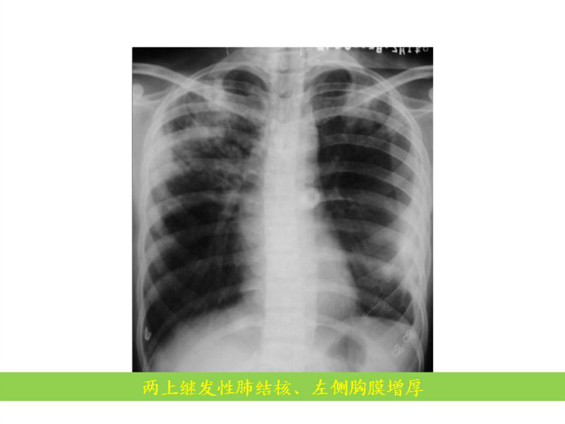 常见影像病例读片汇总
