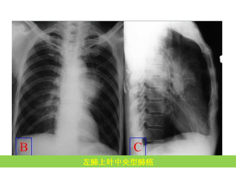 常见影像病例读片汇总