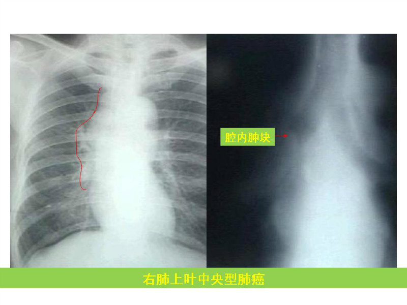 常见影像病例读片汇总