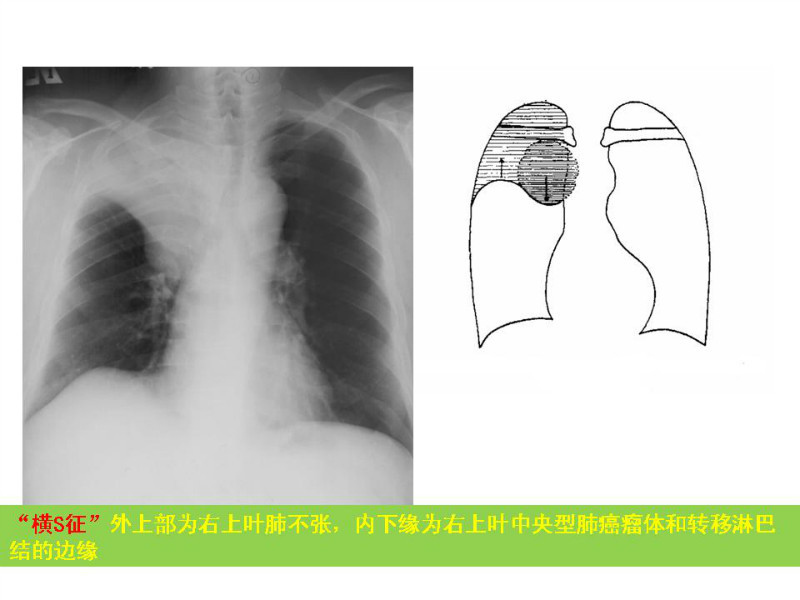 常见影像病例读片汇总