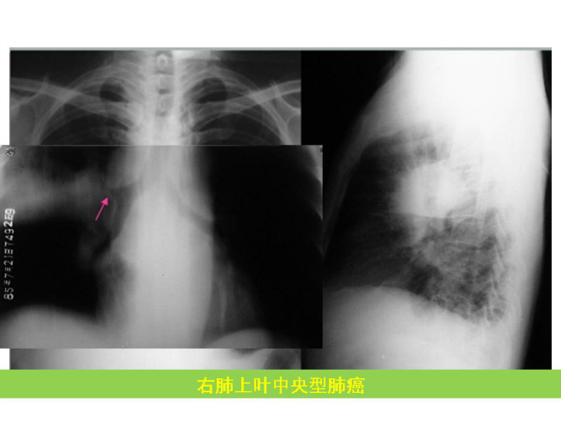 常见影像病例读片汇总