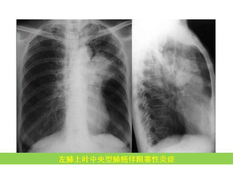 常见影像病例读片汇总
